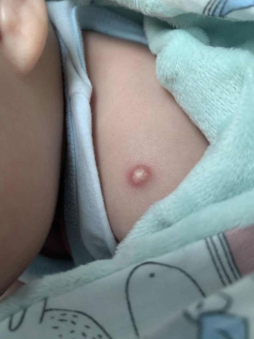 สอบถามแม่ๆค่ะเรื่องปลูกฝีดาษ