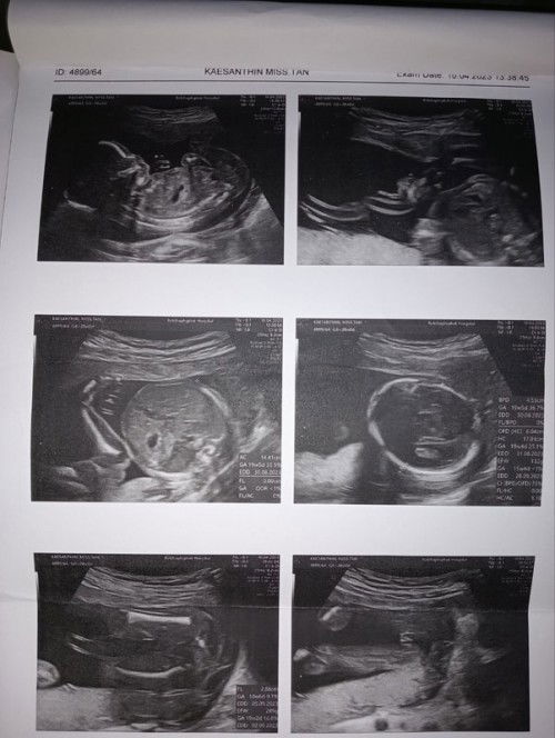 ผู้หญิงหรือผู้ชายท้อง5เดือน