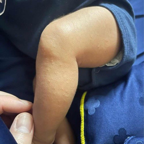 น้องเป็นผื่นขึ้นตามตัวแบบนี้ เกิดจากอะไรคะ