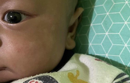 Bercak Putih di Pipi Bayi