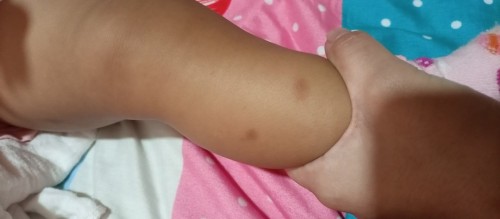 Pantanggal ng peklat ni baby