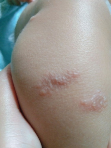 Bentolan di kulit bayi 2 buln 20 hari