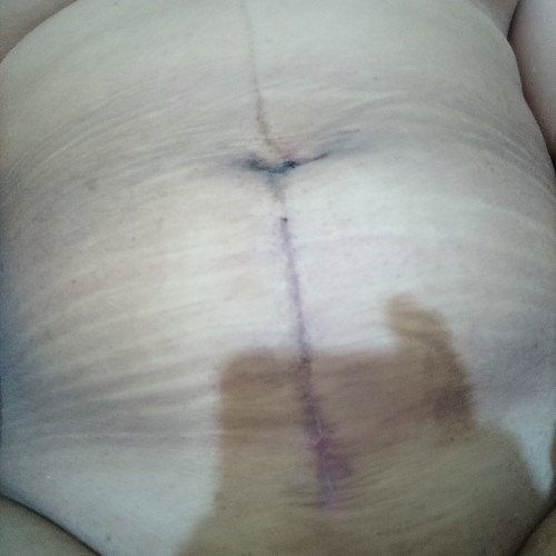 CS wound scar