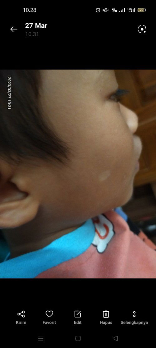 Putih putih pada kulit anak