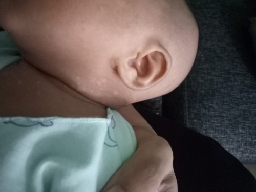 Bund ada yg tau ini kenapa ya bayiku kok ada beginian d lehernya...mayan bnyak