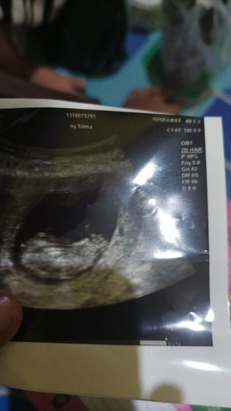 Perbedaan usia kehamilan