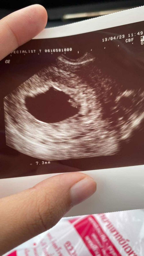 เสียใจมากคะ😭 แม่ๆแบบนี้น้องไม่ยุด้วยแร้วใช่ไหมคะ ไปซาวน์ตอน7วีคเจอหัวใจน้องหัวใจน้องเต้น วันนี้10วีคไปหาหมอไม่เจอหัวใจแร้วคะ