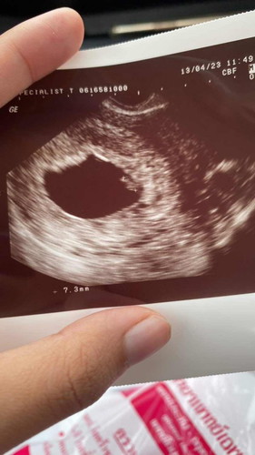 เสียใจมากคะ😭 แม่ๆแบบนี้น้องไม่ยุด้วยแร้วใช่ไหมคะ ไปซาวน์ตอน7วีคเจอหัวใจน้องหัวใจน้องเต้น วันนี้10วีคไปหาหมอไม่เจอหัวใจแร้วคะ