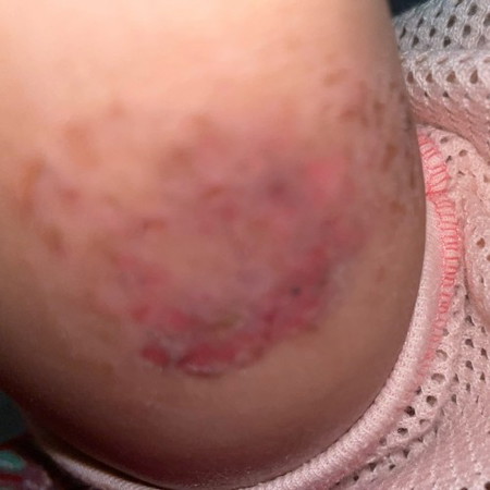Kaki baby gatal