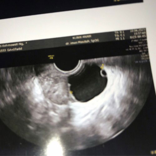 Usg kista atau kantong