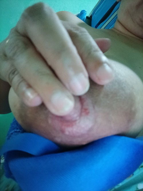 Sugat sa breast simula ng magka ngipin si baby,