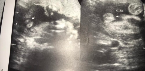 Gender for baby