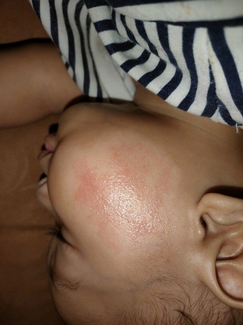 Kulit bayi kasar dan bekasnya putih putih