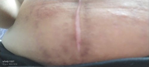 คันหน้าท้อง