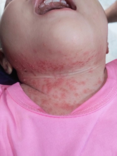 Anak saya lehernya kok ada bintik bintik merah ada yg prnah alami ngga ..untuk obatnya apa yah bund