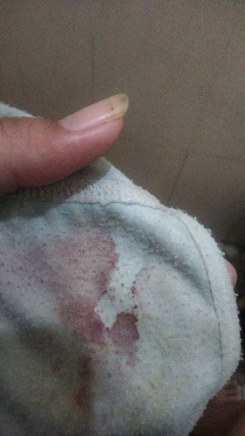 Keluar darah saat hamil 32 week