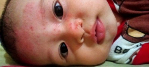 Bunda kira kira itu alergi apa ya dan cara mengatasinya gmna