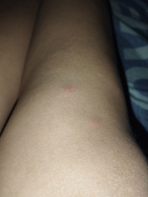 LOTION ALLERGY/HINDI HIYANG