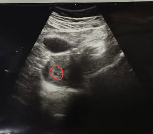 เลือดออกขนาดตั้งครรภ์ไตรมาสแรก