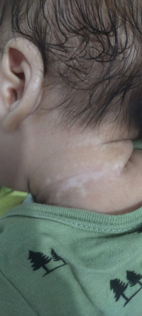 Ruam putih pada bayi