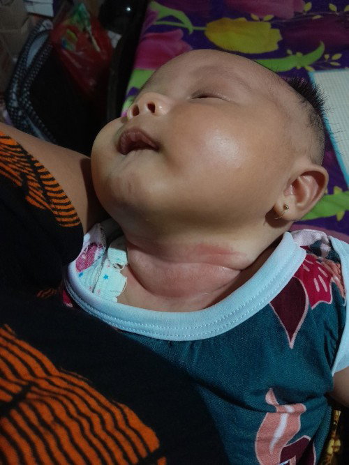 Leher bayi merah/ruam
