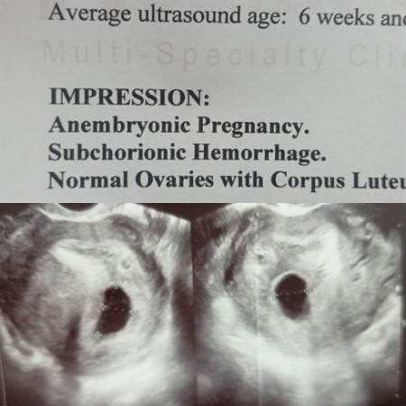 Anembryonic pregnancy