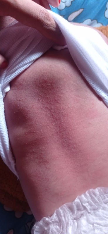 gatal / merah di pungung