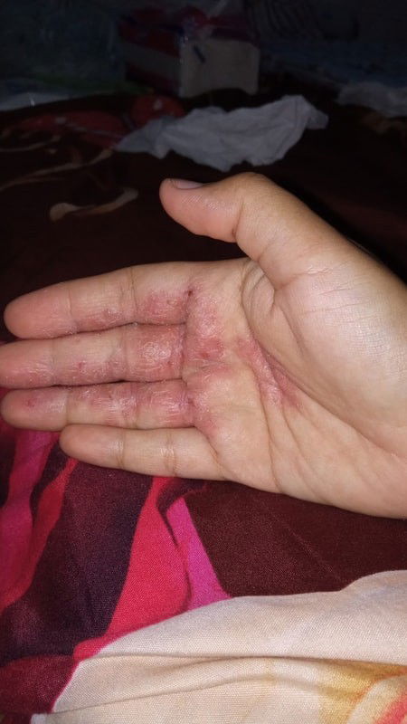 obat alergi sabun apa y?