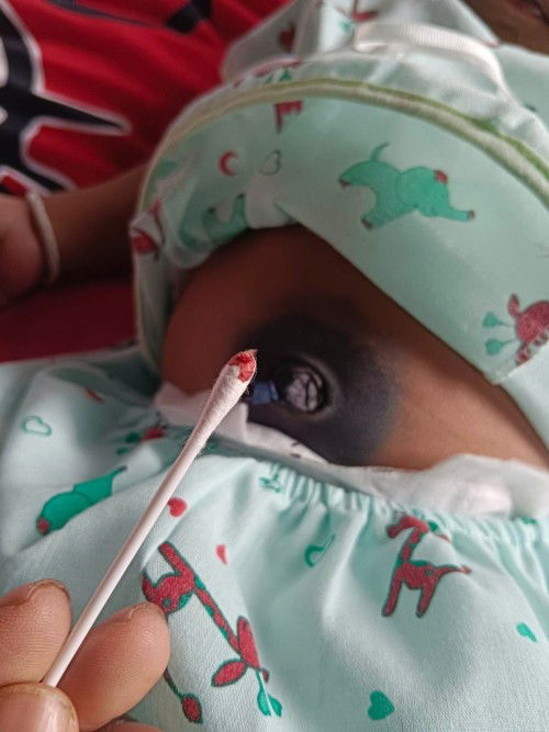 สะดือน้องมีเลือด