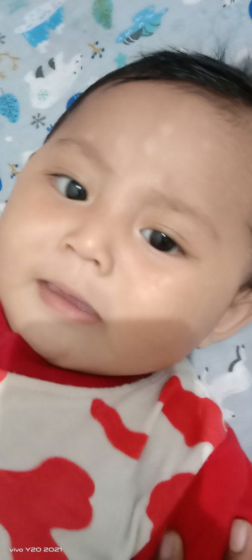 Bercak putih pada bayi