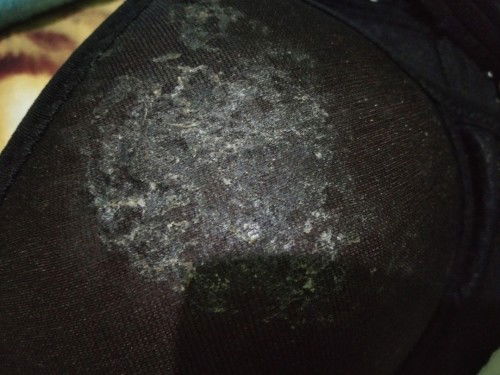 Payudara gatal dan mengelupas