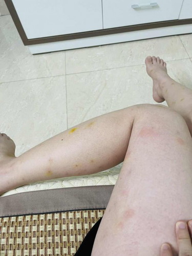Các mom có ai bị mẩn ngứa như e k ạ
e bầu 24w chả hiểu bị gì có nên đi khám k nhỉ
