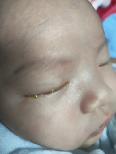 น้องมีขี้ตาตลอด ตาแฉะ