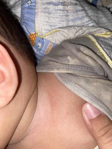 rashes used calmoseptine pero nagdry