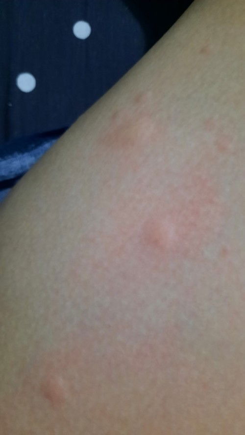 Gatal gatal saat hamil muda