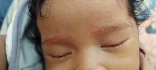 Beruntusan kuning di alis