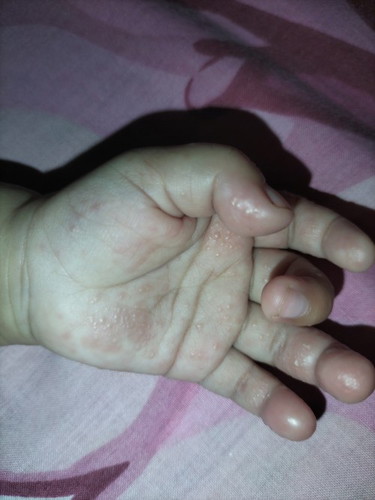 Bintik berair umur 9 bulan