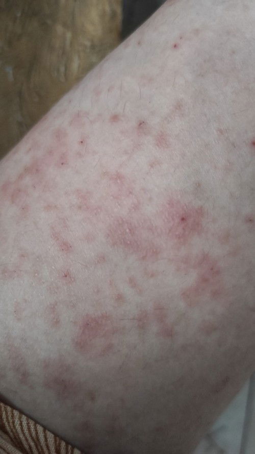 36w Gatal-gatal / dermatitis