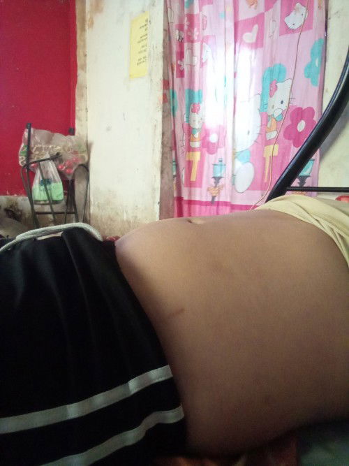 Still no fetal movement?