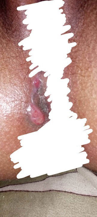 Perineal tear infection or reopen?