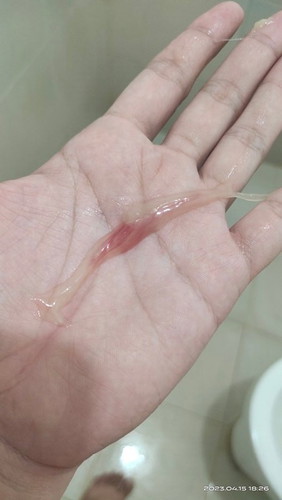 Mucus plug