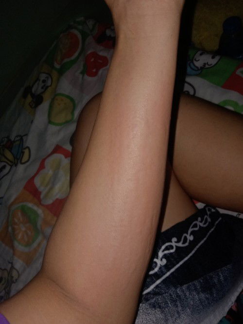 เป็นผื่นลมพิษเป็นปื้นๆข้นทุกครั้งที่เกา