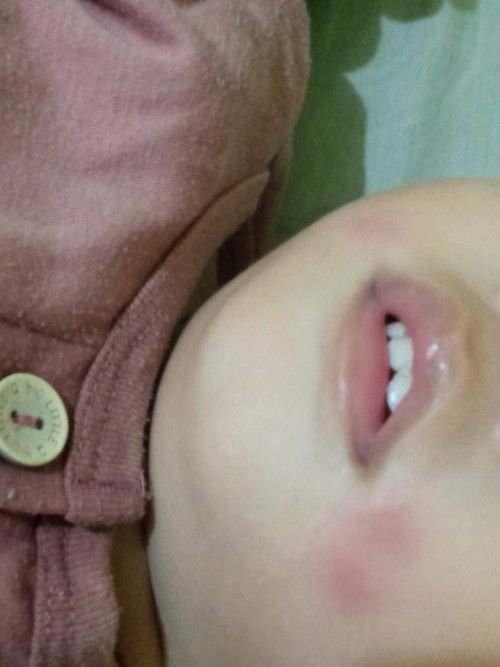 Adakah bunda2 yg anak nya tiba2 ada ruam di kiri kanan bibir..solusinya gimana ya