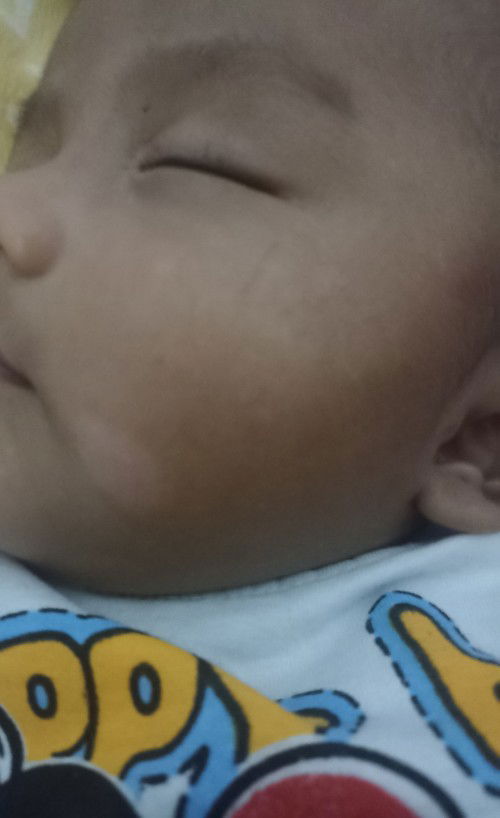 Ruam lama² jadi putih