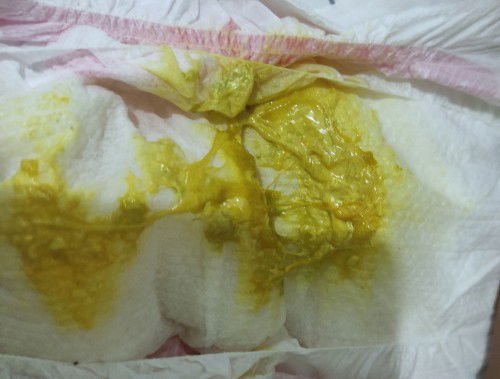 Mga mi, kanina napansin ko parang iba poops ni baby, parang may plema, normal lang po ba ito?