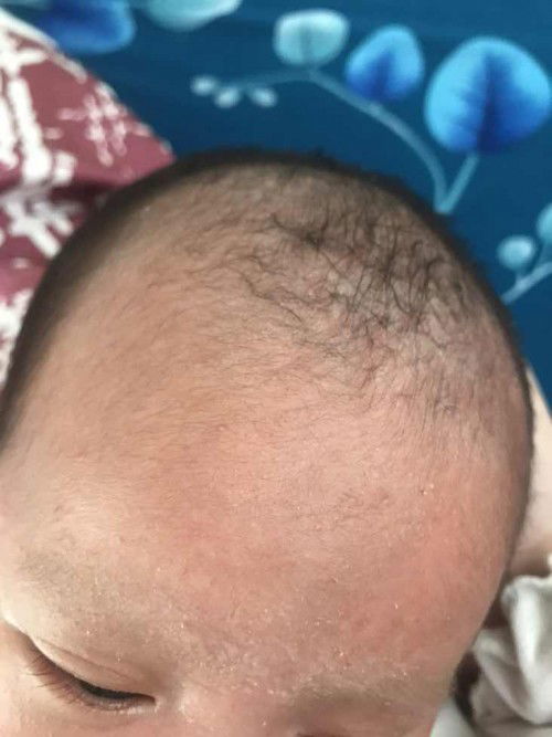 Bé bị đóm trắng vậy làm sao hết đây các kom