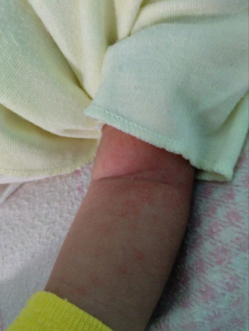 Salep gatal untuk bayi