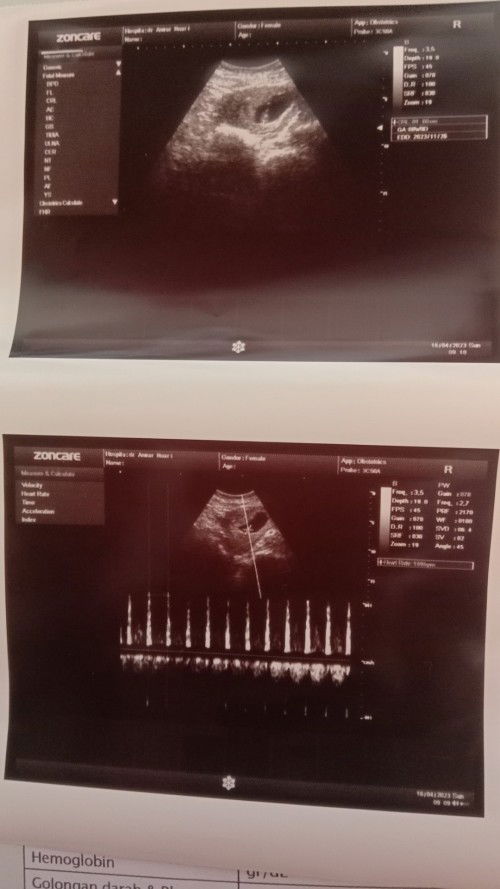 Hasil usg sudah terlihat