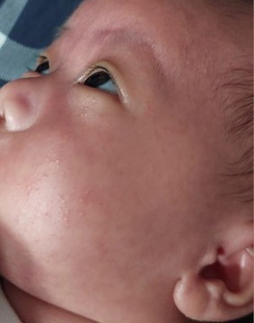 Baby acne?