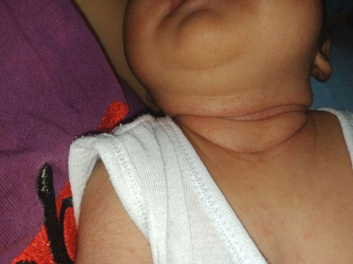 Need help
Mga mie ano po Kaya itong NASA leeg ni baby ?